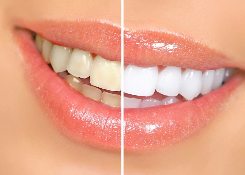 Công nghệ tẩy trắng răng Ultra Perfect Whitening, tẩy trắng răng công nghệ Ultra Perfect Whitening