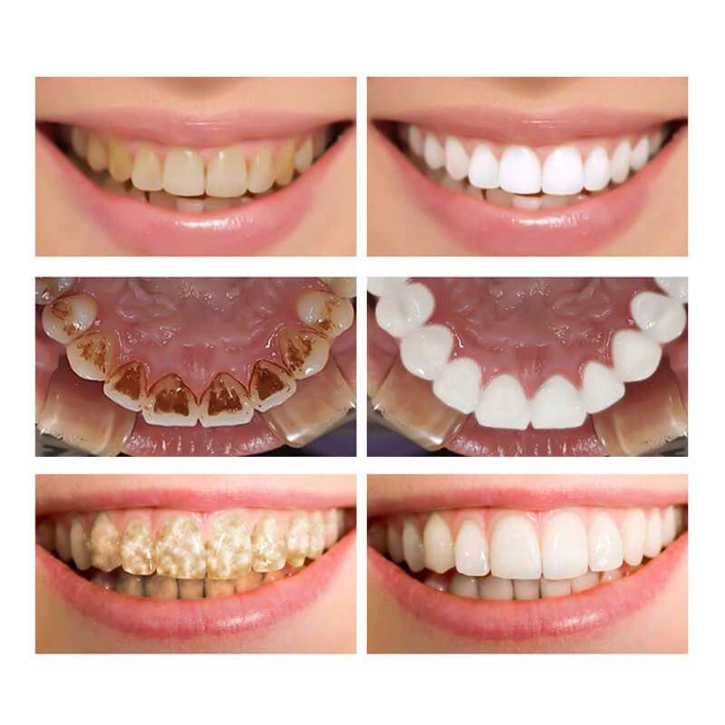 Công nghệ tẩy trắng răng Ultra Perfect Whitening, tẩy trắng răng công nghệ Ultra Perfect Whitening