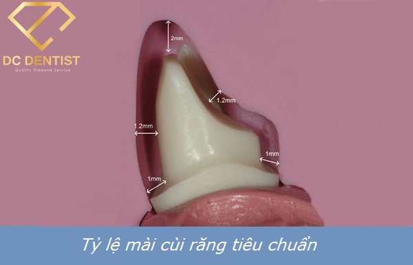 Răng mọc không đều phải làm sao, tại sao răng mọc không đều, hình ảnh răng mọc không đều, bọc răng sứ cho răng mọc không đều, niềng răng mọc không đều, nên niềng răng hay bọc răng sứ cho răng mọc không đều