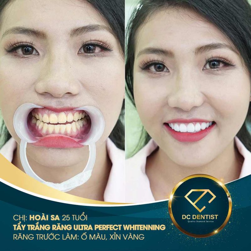 Hình ảnh khách hàng tẩy trắng răng Ultra Perfect Whitening