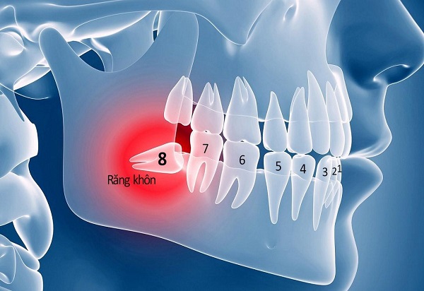 Nhổ răng khôn ăn toàn, không đau bằng công nghệ độc quyền chỉ có tại DC Dentist