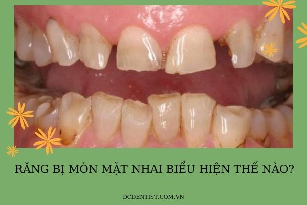 cách chữa răng mòn mặt nhai, răng mòn mặt nhai, mòn răng mặt nhai, chữa răng mòn mặt nhai, trám răng mòn mặt nhai, mòn mặt nhai răng hàm, điều trị răng mòn mặt nhai, răng bị mòn mặt nhai, răng hàm bị mòn mặt nhai, mòn răng quá mức, mặt nhai của răng bị mòn, 