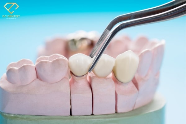 bọc răng sứ cho răng sâu bao nhiêu tiền, bọc răng sứ cho răng sâu, giá bọc răng sứ bị sâu, giá bọc răng sứ cho răng sâu, bọc sứ răng sâu giá bao nhiêu