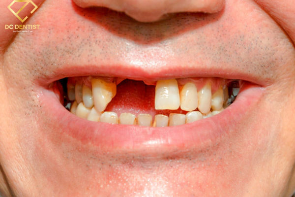 sau khi niềng răng có ảnh hưởng gì không, Niềng răng có hại cho sức khỏe không, niềng răng xong có ảnh hưởng gì không, niềng răng xong có hại gì không