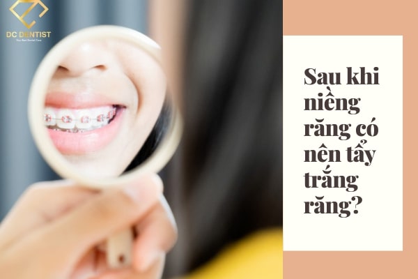 Chuyên gia giải đáp sau khi niềng răng có nên tẩy trắng răng không?