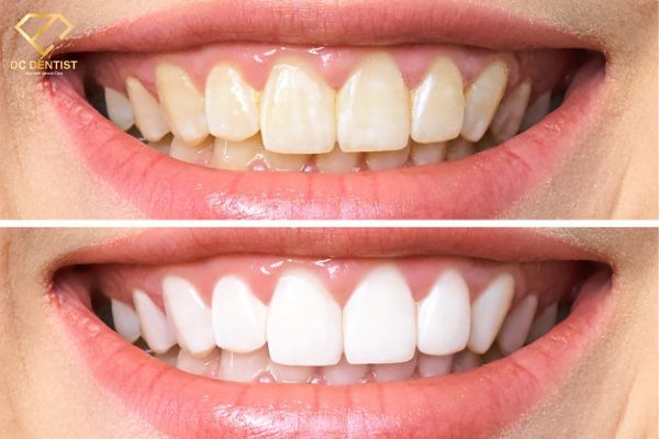 Tẩy trắng răng công nghệ UlTRA PERFECT WHITENING giá chỉ 990K tại Nha khoa Quốc tế DC Dentist