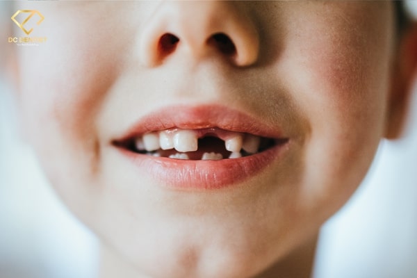 Bị xiết ăn răng là gì? Điều trị xiết ăn răng như thế nào?