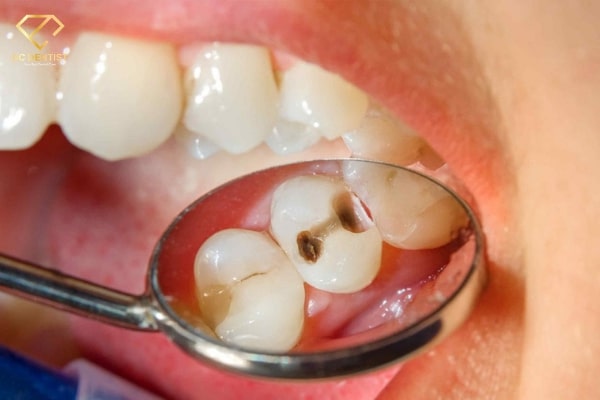 bị xiết ăn răng là gì, xiết ăn răng, xiết ăn răng là gì, bị xiết ăn răng, chữa xiết ăn răng, cách trị xiết ăn răng tại nhà, cách trị xiết ăn răng ở người lớn, cách chữa xiết ăn răng, triệu chứng bị xiết ăn răng, bé bị xiết ăn răng
