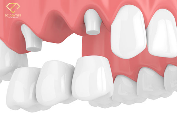 Răng toàn sứ Sagemax, Răng sứ Sagemax, Bọc răng toàn sứ Sagemax, Bảng giá răng toàn sứ Sagemax