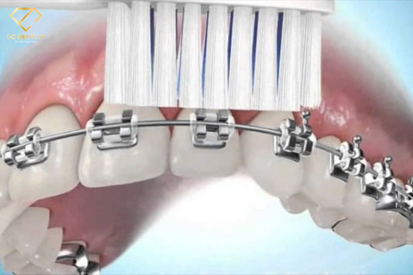 cách đánh răng khi đeo niềng răng, đánh răng khi niềng răng, cách đánh răng khi niềng răng, đánh răng đúng cách khi niềng răng, đánh răng sau khi niềng răng, hướng dẫn đánh răng sau khi niềng răng