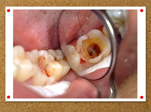 răng hàm bị sâu chỉ còn chân răng, răng hàm bị sâu chỉ còn chân, răng sâu bị vỡ chỉ còn chân răng, răng bị sâu chỉ còn chân răng, sâu răng chỉ còn chân, nhổ răng sâu chỉ còn chân răng