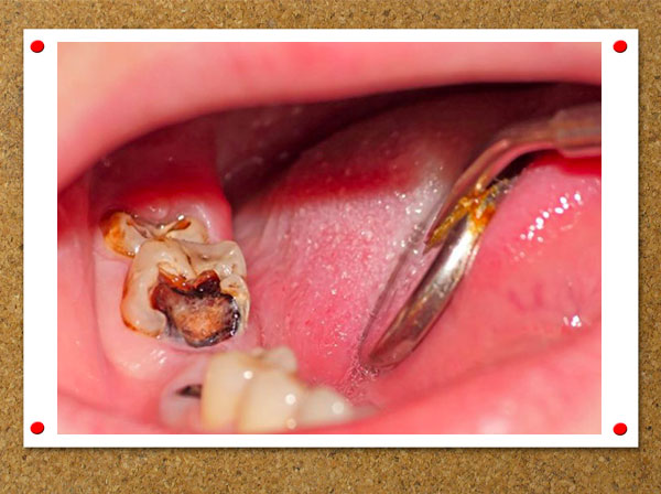 Răng hàm bị sâu chỉ còn chân răng: Tác hại và cách xử lý an toàn