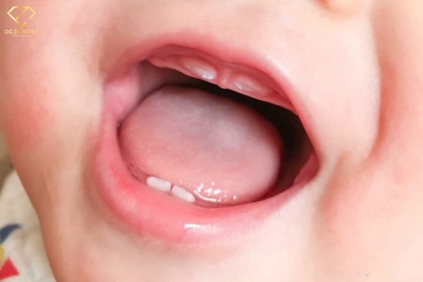 Tìm hiểu tuổi mọc răng sữa của trẻ | Thời gian mọc răng phụ thuộc vào yếu tố nào?