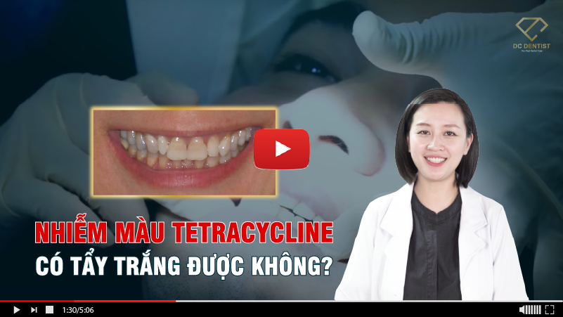 Bác sĩ Nha khoa DC Dentist giải đáp: Nhiễm màu Tetracycline có tẩy trắng được không?