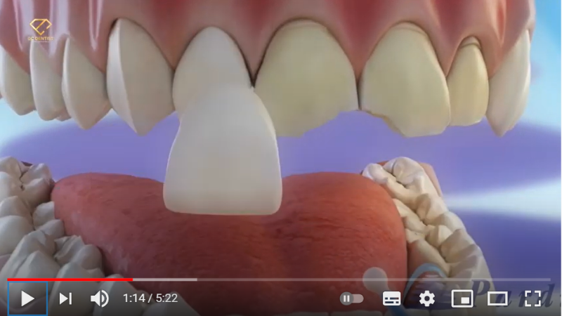 Giải đáp những thắc mắc về dán răng sứ Veneer tại Nha khoa Quốc tế DC Dentist