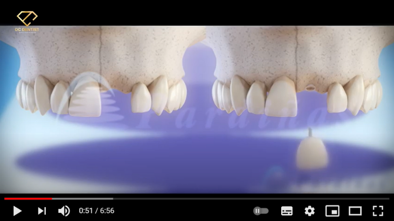Những điều cần biết về Implant và quy trình trồng răng Implant tại Nha khoa DC Dentist
