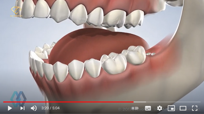Khám phá quy trình nhổ răng khôn tại Nha khoa Quốc tế DC Dentist