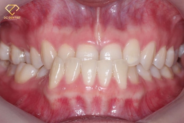 Niềng răng có hết móm không, niềng răng có hết móm, niềng răng hết móm, Hình ảnh trước và sau khi niềng răng món, niềng răng móm có hiệu quả không, bị móm có niềng răng được không