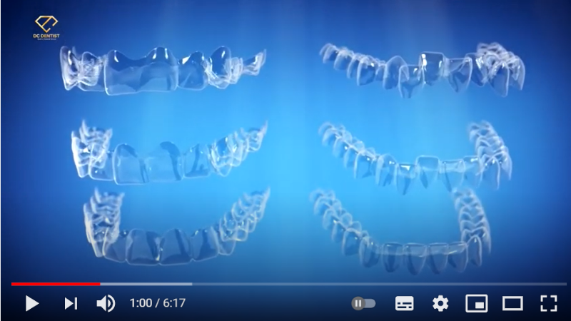 Giải đáp: Niềng răng Invisalign và quy trình niềng răng chuẩn Mỹ tại Nha khoa DC Dentist