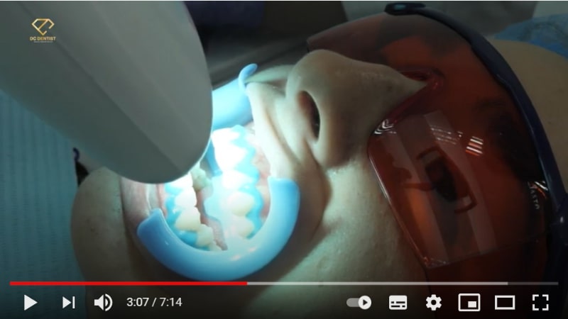 Theo dõi quy trình tẩy trắng răng tại Nha khoa Quốc tế DC Dentist