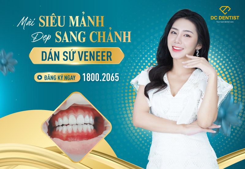[OFF 50%] Dán sứ Veneer – Răng đều đẹp chuẩn đường cười – Khuyến mãi cực lớn!