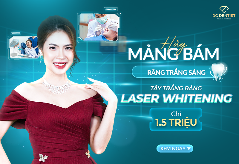 Huỷ mảng bám – Răng trắng sáng: Tẩy trắng răng CN Laser Whitening [Chỉ 1.5 triệu đồng]
